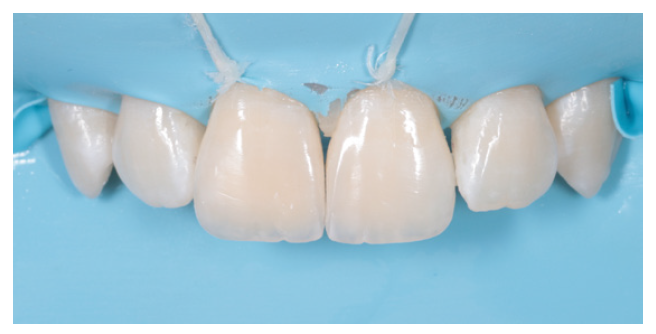 From Trauma to Harmony: A Minimally Invasive Approach To Anterior Aesthetics